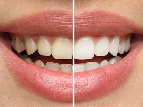 Smile half-whitened to show before/after