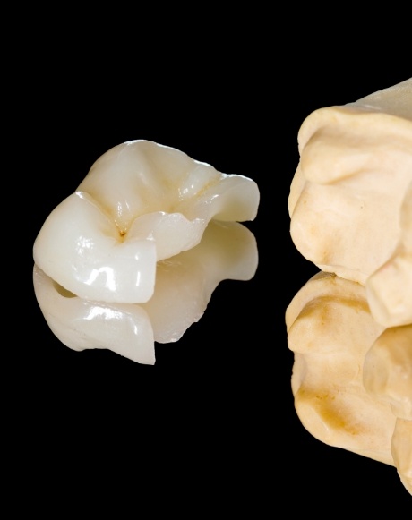 Model tooth with metal free dental crown