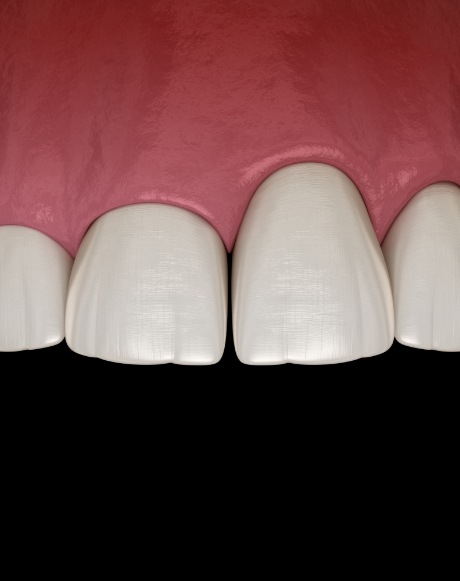 Animated smile with uneven soft tissue before gum recontouring