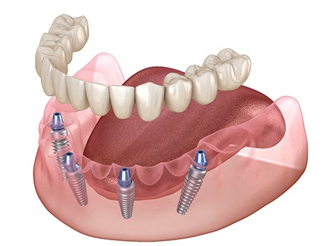 All-On-4 dentures