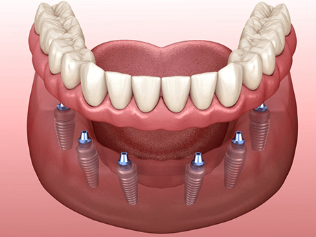 a digital illustration of implant dentures in Marysville