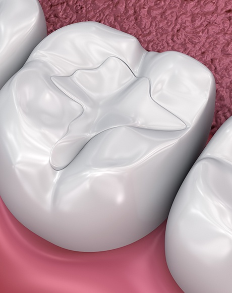 3D rendering of a tooth filled with composite resin material