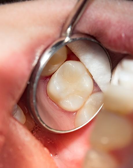 Closeup of a tooth reflected in a dental mirror