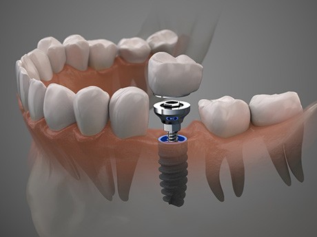 A dental implant in Marysville