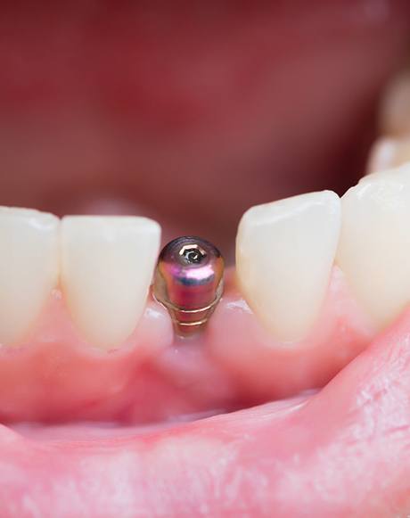 closeup of dental implant in patient’s mouth