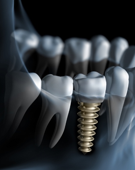 Animated smile with dental implant supported dental crown