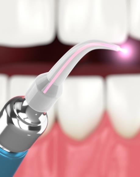 Soft tissue laser dentistry tool