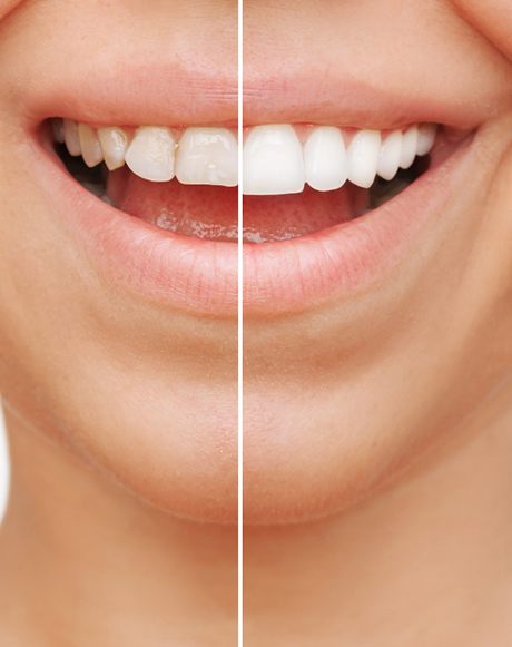 A before-and-after photo of veneers in Marysville