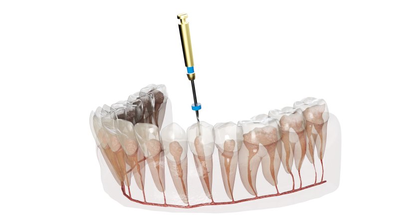 a digital image of a root canal