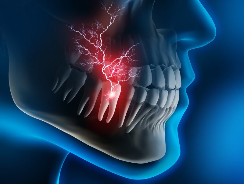 A 3D illustration of a tooth that needs a root canal