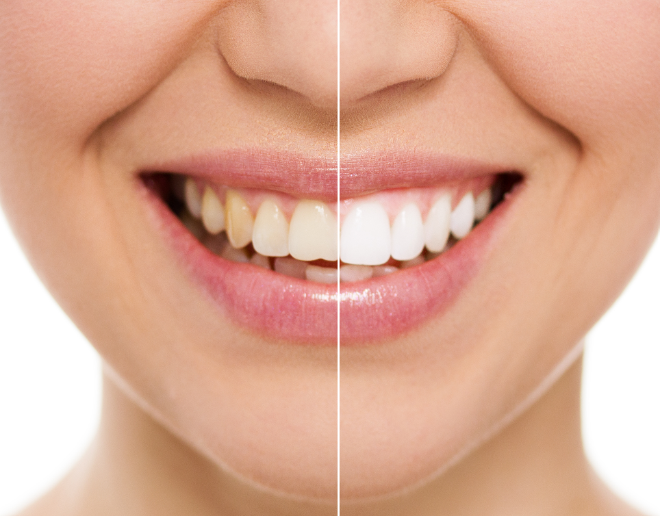 Close up of woman's smile half white teeth, half yellow